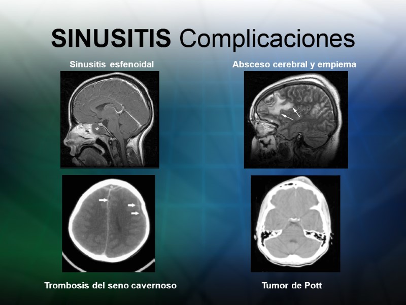 SINUSITIS Complicaciones Sinusitis esfenoidal Absceso cerebral y empiema Tumor de Pott Trombosis del seno